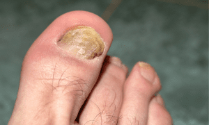 قارچ ناخن منجر به عفونت در خون و نکروز می شود.